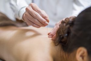 Acupuncture